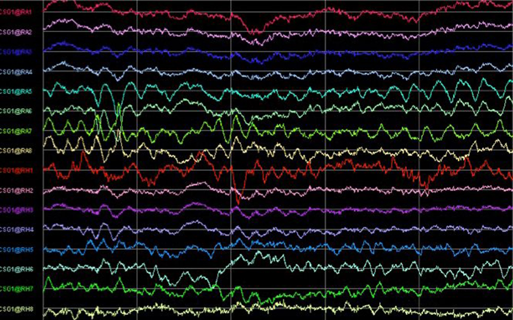 Patient monitor showing vital signs ECG and EKG.
